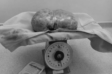 Lấy thành công khối u buồng trứng nặng 5kg