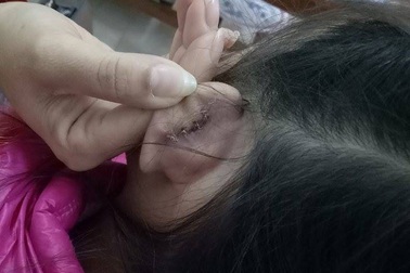 Học sinh lớp 2 bị cô giáo xách đứt tai vì oẳn tù tì trong giờ học