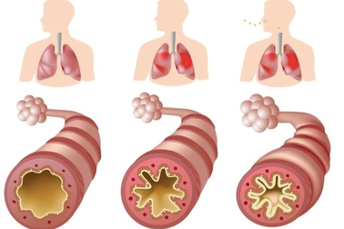 Khoảng 4% người Việt mắc bệnh hen