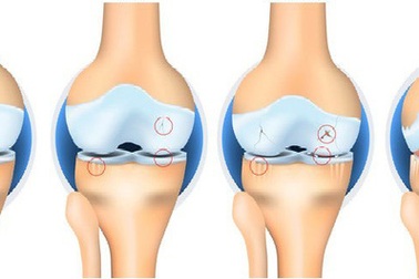 Giải pháp toàn diện cho bệnh nhân thoái hóa khớp