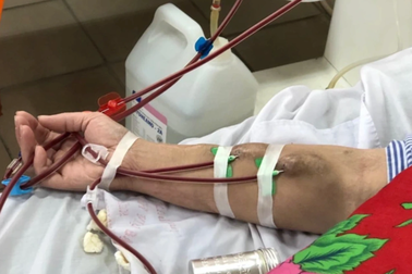 Hơn 33.000 bệnh nhân đang phải lọc máu vì suy thận
