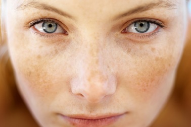 Những điều cần biết về melanin và nám da