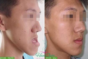 Phẫu thuật ca móm khó 5 năm không khép được miệng