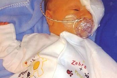 Tổn thương não, mù mắt trái do thủ thuật forcep sai lầm