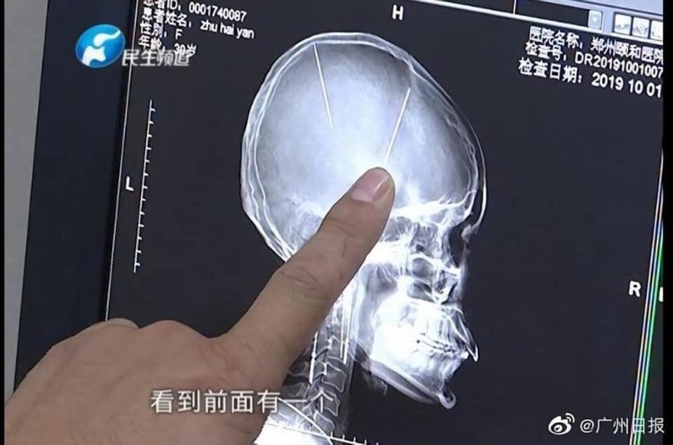 Đến bệnh viện sau va chạm giao thông, không ngờ phát hiện vật lạ cắm sâu trong não - 1 Đến bệnh viện sau va chạm giao thông, không ngờ phát hiện vật lạ cắm sâu trong não - 1