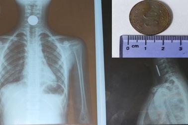 Gắp đồng xu có đường kính hơn 2cm từ thực quản bé gái