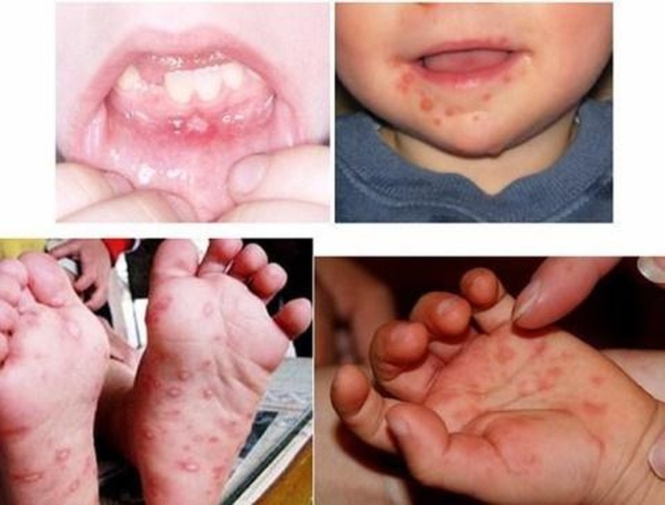 Bệnh tay chân miệng ở trẻ nhỏ và giải pháp độc đáo từ bộ đôi sản phẩm Subạc - 2 Bệnh tay chân miệng ở trẻ nhỏ và giải pháp độc đáo từ bộ đôi sản phẩm Subạc - 2