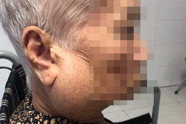 Má căng phồng vì khối u to bằng quả cam