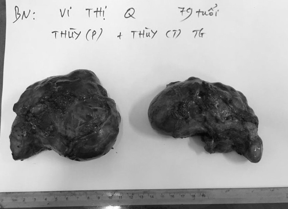 Phẫu thuật giải thoát cho cụ bà khỏi những khối u siêu khổng lồ - 3