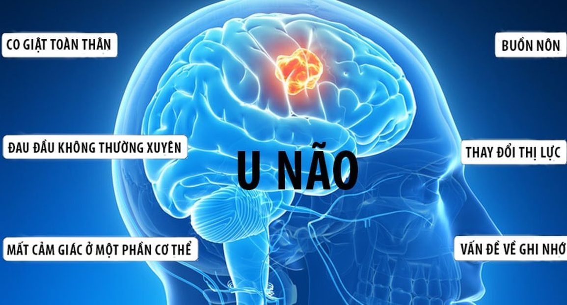 8 dấu hiệu cảnh báo khối u xuất hiện ở não - 2 8 dấu hiệu cảnh báo khối u xuất hiện ở não - 2