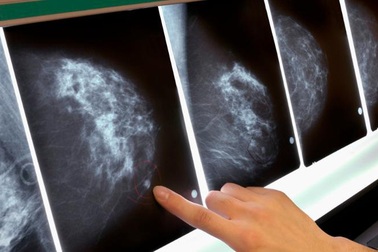 Phát hiện "thời điểm vàng" ngăn chặn ung thư di căn