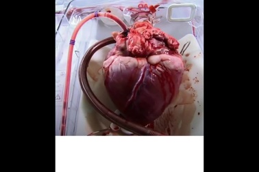 Các bác sĩ làm thế nào để giữ quả tim cấy ghép luôn đập trong ca phẫu thuật?