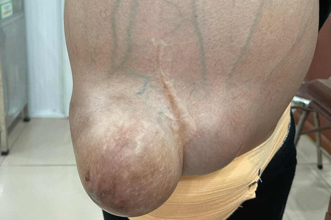 Uống thuốc nam khiến khối u 20kg ăn đến xương, người mẹ 24 tuổi nguy kịch - 1 Uống thuốc nam khiến khối u 20kg ăn đến xương, người mẹ 24 tuổi nguy kịch - 1