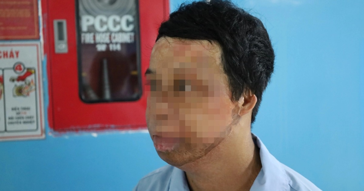 Chàng trai hóa “ngọn đuốc sống” vì hút thuốc khi đổ xăng, đi mổ hơn 20 lần