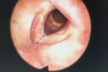 TPHCM: Phát hiện ca bệnh hiếm gặp, mắc cùng lúc 2 loại ung thư