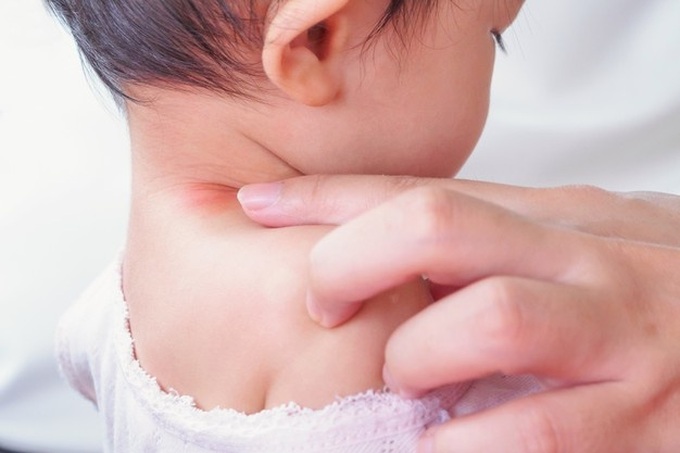 Khi trẻ có mụn, nhọt cha mẹ không được tự ý chích, nặn hoặc dùng các loại cao dán, lá cây để đắp vì dễ gây viêm loét diện rộng, gây nhiễm trùng máu. Ảnh minh họa