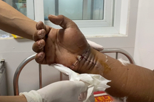 Xuyên đêm cứu bàn tay bị cưa máy cắt đôi