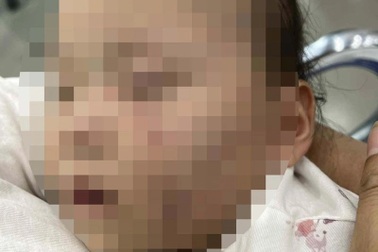 Vụ bé gái chi chít vết bầm trên mặt sau khi đi lớp: Tạm giữ một cô giáo