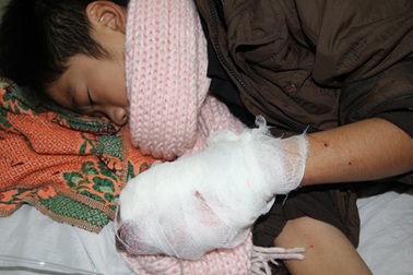 Nghịch pháo, một học sinh nát bàn tay