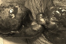 Xoắn tinh hoàn trong đêm, cậu bé suýt “mất đạn”