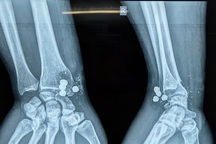 Nam thanh niên nghịch súng kíp, 5 viên đạn nổ găm vào cổ tay