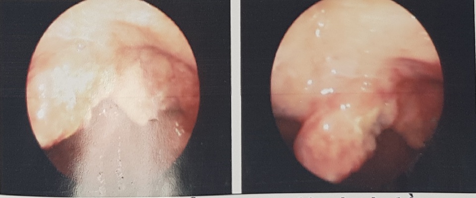 Tưởng sùi mào gà miệng hóa mắc bệnh ung thư hiếm - 1 Tưởng sùi mào gà miệng hóa mắc bệnh ung thư hiếm - 1