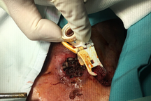 Giòi làm tổ lúc nhúc trong lỗ mở khí quản của bệnh nhân