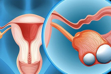8 cách giảm nguy cơ ung thư buồng trứng