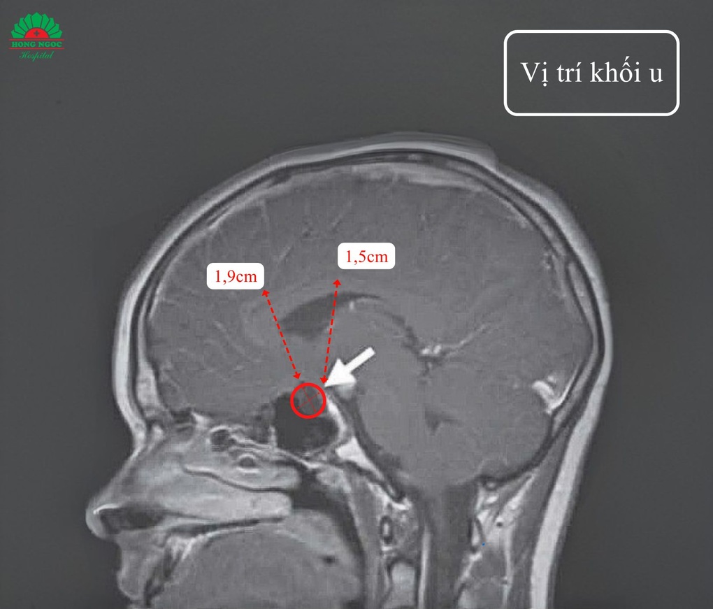 Une fillette de 6 ans découvre de manière inattendue une tumeur cérébrale lors d'un dépistage précoce de la puberté - 2 Bé gái 6 tuổi bất ngờ phát hiện khối u vùng não khi tầm soát dậy thì sớm - 2