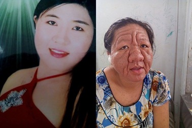 Cảnh báo “thảm họa” lạm dụng corticoid từ mỹ phẩm, dược phẩm