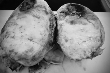 Bất ngờ phát hiện khối u nặng 3 kg trước ngực, sau nhiều ngày khó thở