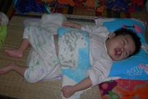 Bé 18 tháng tuổi bị u máu, bại não, mù bẩm sinh