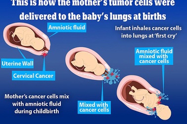 Sốc: 2 trẻ sơ sinh Nhật Bản hít phải tế bào ung thư từ mẹ