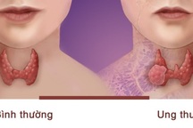 Loại bệnh ung thư phụ nữ dễ mắc hơn nam giới