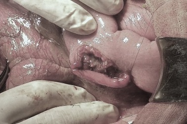 Nguy kịch vì bị cọc nhồi bê tông ép vỡ nội tạng