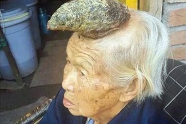 Cụ bà mọc “sừng” dài 13cm trên đầu