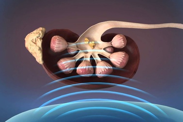 Cách điều trị sỏi thận to cho người sợ đau