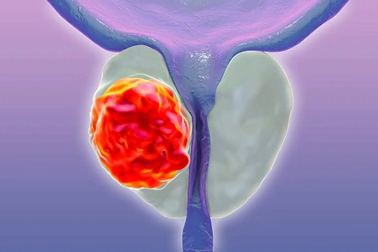 Ung thư và u xơ tuyến tiền liệt khác nhau như thế nào?