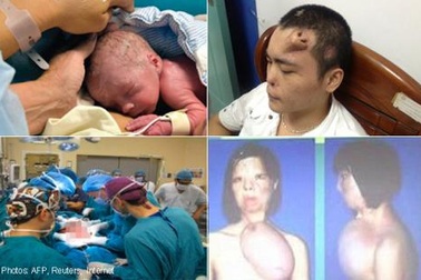 Những ca ghép bộ phận cơ thể hy hữu trên thế giới