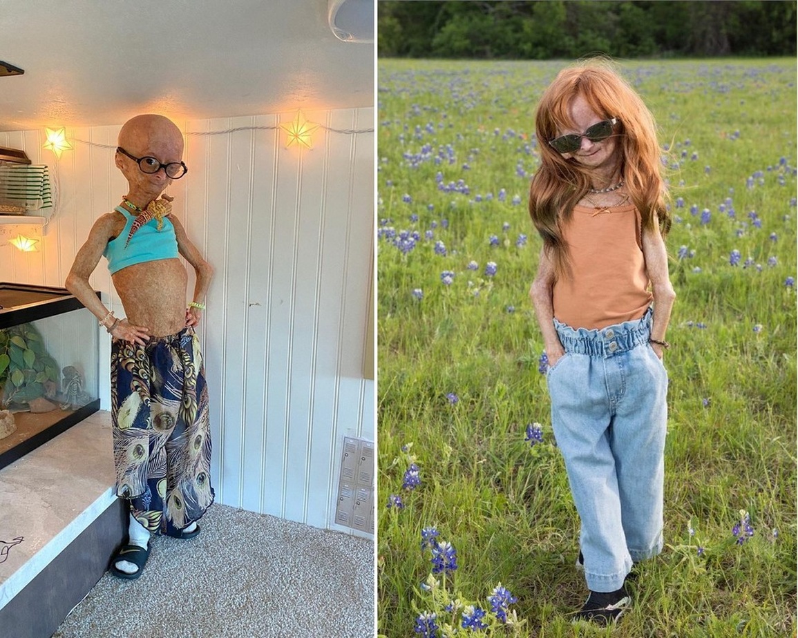 Dù mắc hội chứng hiếm gặp, Adalia Rose luôn thể hiện sự lạc quan và yêu đời (Ảnh: Instagram). Dù mắc hội chứng hiếm gặp, Adalia Rose luôn thể hiện sự lạc quan và yêu đời (Ảnh: Instagram).