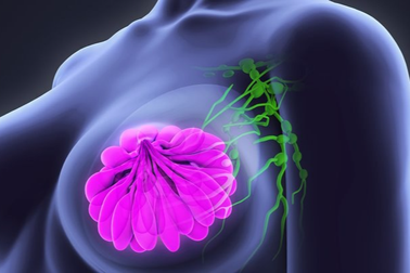 Một số tác dụng phụ của xạ trị ung thư vú