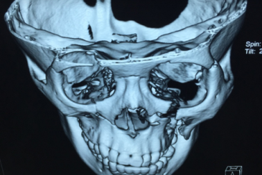 Xót xa những gương mặt con trẻ khôi ngô bỗng chốc "vỡ nát" vì tai nạn
