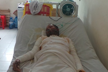 Trữ dầu hỏa trong bếp, một phụ nữ bỏng nặng