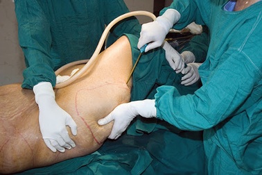 14 giờ sau hút mỡ bụng, người phụ nữ tử vong