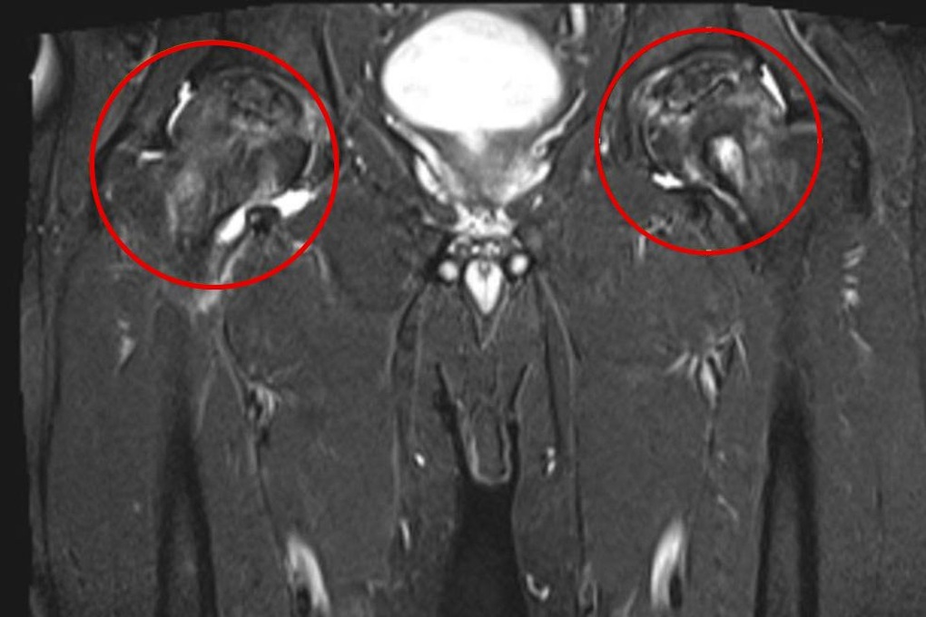 Phát hiện hoại tử chỏm xương đùi độ IV do đau háng đột ngột - 1