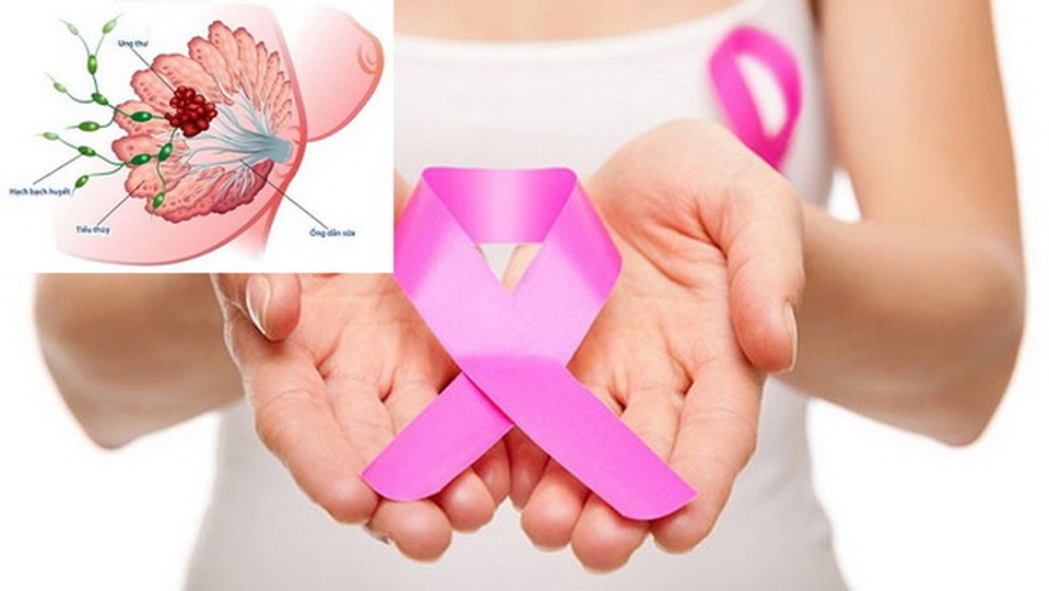 Sáng kiến toàn cầu mới về ung thư vú: Cải thiện khả năng sống sót cho người bệnh - 1 Sáng kiến toàn cầu mới về ung thư vú: Cải thiện khả năng sống sót cho người bệnh - 1