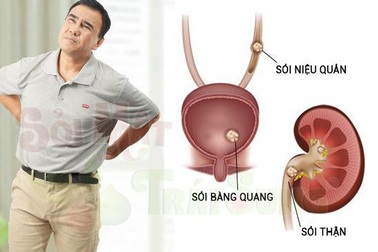 Bí quyết giúp bạn đối phó với bệnh sỏi thận hiệu quả