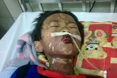 Bé trai nổi bọng nước toàn thân, lở loét vì quả dại