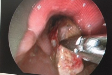 Hóc xương cá tám tháng mà không biết