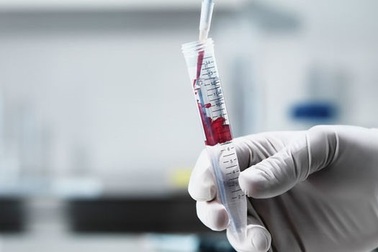 Phương pháp mới xét nghiệm máu để phát hiện ung thư gan